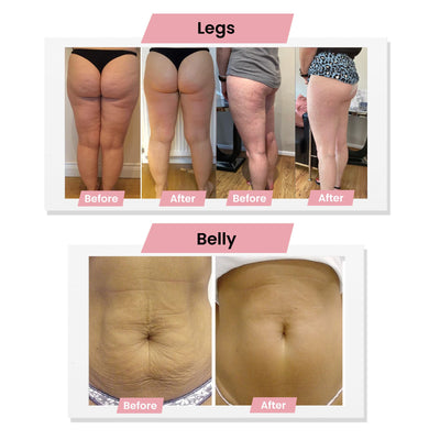 Anti-Cellulite Massager